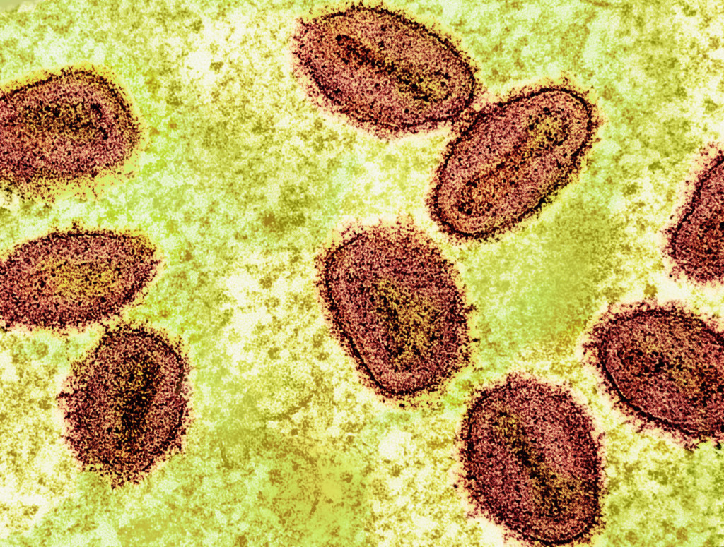 Mpox: conheça sintomas e tire principais dúvidas sobre a doença Mpox: conheça sintomas e tire principais dúvidas sobre a doença